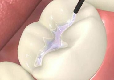 Pit & Fissure Sealant