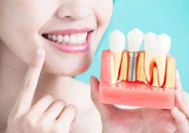 Dental Implants