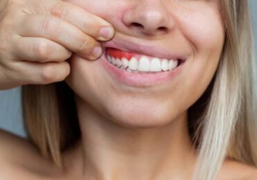 Gingival Flap Surgery